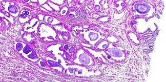 Addition of Pelvic Lymph Node Radiation may Significant Improve Prostate Cancer Treatment