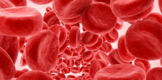 ASH 2025: Despite Guidelines, Iron Overload Remains Prevalent in Individuals with Sickle Cell Disease
