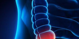 Retrospective Review finds Over Diagnosis of Appendix Cancer