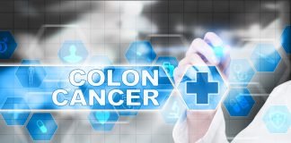 Study: A New Test May Help Identify Patients Diagnosed with Colorectal Cancer who Benefit From NSAIDs