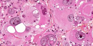 Study Shows Activating Antiviral Immune Responses makes Glioblastoma more Susceptible to Treatment Glioblastoma with extreme nuclear enlargement.
