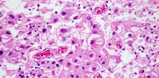 Helping Surgeons Find Liver Tumors – Not Nick Blood Vessels