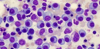 Carfilzomib and Dexamethasone Reduced the Risk of Death by 21% Compared to Bortezomib and Dexamethasone in Relapsed or Refractory Multiple Myeloma Patients