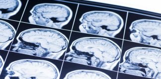 Study: Laser Heat Therapy + Immunotherapy may Dramatically Improve Survival for Patients Diagnosed with Glioblastoma