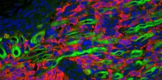 Researchers Pinpoint Cell Type that Turns Malignant in Rhabdomyosarcoma