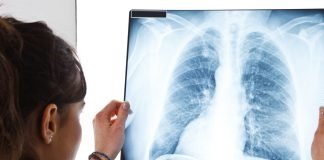 Zongertinib + NGS-based Companion Diagnostic to Advance Personalization of Lung Cancer Treatment Lung radiography | Doctor examining a lung radiography