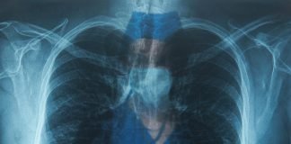 Survey Shows Public to be Embarrassingly Ignorant about Lung Cancer
