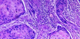 Researchers Identify Protein that Makes Skin Cancer Cells More Invasive