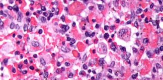 FDA Approval of Emapalumab Marks Significant Improvement in Primary HLH Induction Therapy