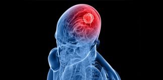 Focused Ultrasound-assisted Treatment helps drugs Cross Blood Brain Barrier