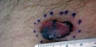 Comparison of State-by-State Data Shows Melanoma Survival Varies Regionally