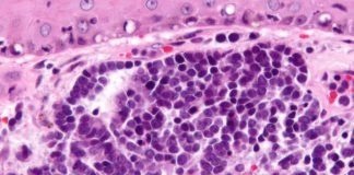Pembrolizumab as 1st-line Therapy for Merkel Cell Carcinoma Shows Improved Survival