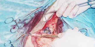 Novel Drug offers Promise for Patients with Ovarian or Pancreatic Cancers Surgery. Removal of cancerous ovarian tumors