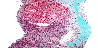 Guideline on External Beam Radiation for Primary Liver Cancer Outline Best Patient-Centered Care Low magnification micrograph of hepatocellular carcinoma the most common form of primary liver cancer. Features on image: End-stage cirrhosis - blue collagen (fibrosis); Mallory bodies; Loss of normal liver architecture; Nuclear atypia.