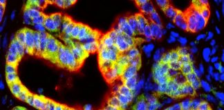 Scientists Discover Previously Unknown Role of Immune Signaling Protein in Pancreatic Cancer Mouse pancreatic tumor cells, in red, produce the signaling protein IL-1β ( in green) to support cancer growth by suppressing the immune system. Photo Courtesy: 2020 NYU Grossman School of Medicine.