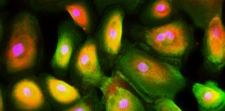 Radiation, Inflammation and Triple-Negative Breast Cancer: A Study Triple negative breast cancer cells showing abnormal expression basal-like markers not found on normal breast epithelial cells. Cells are stained with cytokeratins 14 (green) and 19 (red). Photo courtesy: Bill Schmitt.