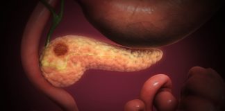 Novel Blood Test Could Identify Therapeutic Response and Avoid Ineffective Therapies Featured Image: Cancerous cells forming a lump in the pancreatic tissue. Photo courtesy: Scientific Animations. Licensed under the Creative Commons Attribution-Share Alike 4.0 International license.