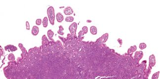 U.S. FDA approves Phase 3 Study Design for Zilovertamab in the Treatment of Mantle Cell Lymphoma Low magnification micrograph of mantle cell lymphoma of the terminal ileum. Endoscopic biopsy. H&E stain. Photo Courtesy: 2020. Nephron. This file is licensed under the Creative Commons Attribution-Share Alike 3.0 Unported license.