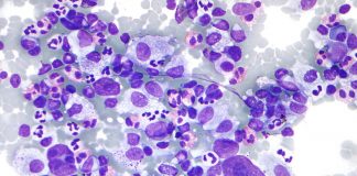 Anti-CD30 CAR-T Cell Therapy Shows Promising Results in Relapsed and Refractory Hodgkin Lymphoma