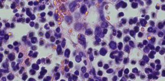 Combinability: Addressing Unmet Need in AML