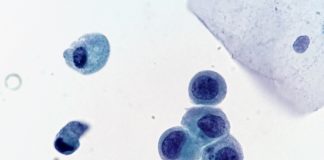 Study Shows Urine-based Liquid Biopsy Outperforms Urine Cytology in Detecting Bladder Cancer