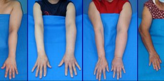 Lymphedema: A Constant Reminder a Patient’s Cancer Journey