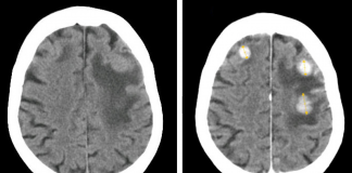 Are Cytology and Imaging Adequate for the Diagnostic Management of Brain Metastasis?