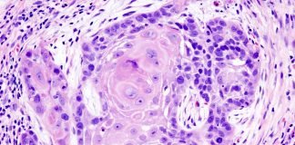 SNS-301 + Pembrolizumab well Tolerated as Treatment of Squamous Cell Carcinoma of the Head and Neck