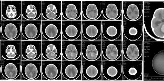 Study Sheds Light on Treatment Options for Medulloblastoma