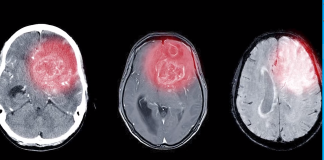 A New Biomimetic Formulation for the Treatment of Glioblastoma
