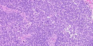 BET Inhibitors may help Overcome a Newly Recognized Form of Resistance to Prostate Cancer Drugs