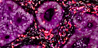 Enhancing the Immune System may help Combat Colorectal Cancer