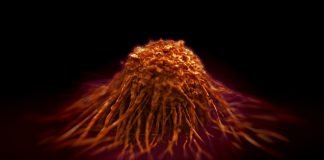 Advanced Technology Helps to Better Detect, Monitor and Treat Brain Cancer