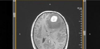 Interleukin-7 Revs up the Immune System Against Glioblastoma