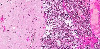 Immune Cell ‘Fingerprints’ on Tumors Metastasized to the Brain may Offer Clues for Future Therapies