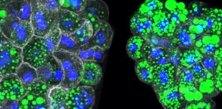 Genetic Alterations Increase the risk of Developing NASH and Fatty Liver in Normal-weight People