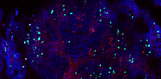 Study Uncovers the Double-edged Function of T-cells in Colorectal Cancer