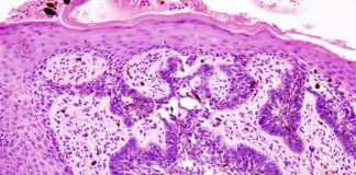 A New Clinical Practice Guideline on Immunotherapy for the Treatment of Nonmelanoma Skin Cancer