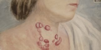 Hypericin-Mediated Photodynamic Therapy in Cutaneous T-Cell Lymphoma