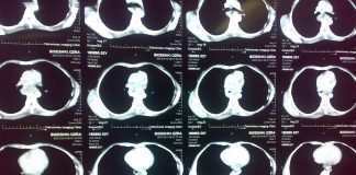 Research Shows Genetic Variation may Explain Racial Disparity in Esophageal Cancer