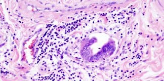 FDA Approves Durvalumab + Chemotherapy as Immunotherapy Regimen in Advanced Biliary Tract Cancer