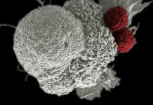 Carl H. June, MD, FAACR, Receives 2023 AACR Award for Lifetime Achievement in Cancer Research Cancer Immunotherapy. Shown here is a pseudo-colored scanning electron micrograph of an oral squamous cancer cell (white) being attacked by two cytotoxic T cells (red), part of a natural immune response. Nanomedicine researchers are creating personalized cancer vaccines by loading neoantigens identified from the patient's tumor into nanoparticles. When presented with immune stimulants, this activates the patient's own immune system, leading to expansion of tumor-specific cytotoxic T cells.