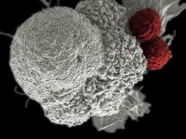 Carl H. June, MD, FAACR, Receives 2023 AACR Award for Lifetime Achievement in Cancer Research Cancer Immunotherapy. Shown here is a pseudo-colored scanning electron micrograph of an oral squamous cancer cell (white) being attacked by two cytotoxic T cells (red), part of a natural immune response. Nanomedicine researchers are creating personalized cancer vaccines by loading neoantigens identified from the patient's tumor into nanoparticles. When presented with immune stimulants, this activates the patient's own immune system, leading to expansion of tumor-specific cytotoxic T cells.