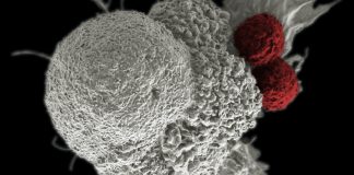 Machine Learning Gives Insight in the Biology Behind Cancer and and Predict Effective Response Cancer Immunotherapy. Shown here is a pseudo-colored scanning electron micrograph of an oral squamous cancer cell (white) being attacked by two cytotoxic T cells (red), part of a natural immune response. Nanomedicine researchers are creating personalized cancer vaccines by loading neoantigens identified from the patient's tumor into nanoparticles. When presented with immune stimulants, this activates the patient's own immune system, leading to expansion of tumor-specific cytotoxic T cells.