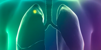 FDA Approves Pafolacianine Injection for Detection of Lung Cancer During Surgery