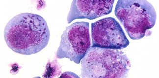Investigational Therapy Shows Promise Against Viral Infections After Stem Cell Transplant