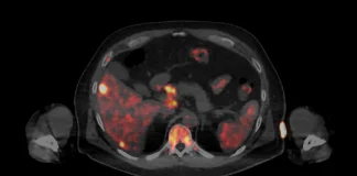 Theranostics Has the Potential to Transform Cancer Diagnosis and Treatment
