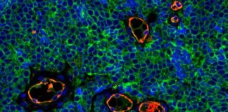 Retifanlimab Approved for Treatment of Metastatic/Recurrent Locally Advanced Merkel Cell Carcinoma