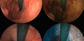 Zolbetuximab Plus CAPOX Improves Survival in Select Gastric Cancers