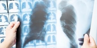 Zoldonrasib Elicits Objective Responses in Patients With KRAS-G12D-mutated Lung Cancer